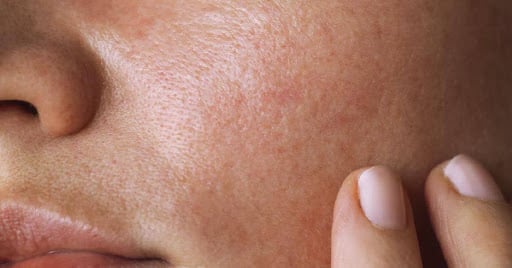 combination skin type