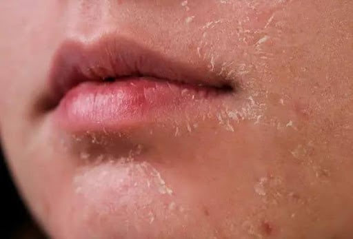 dry skin type