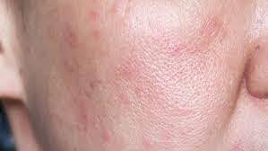 sensitive skin type
